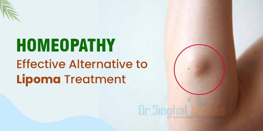 homeopathic treatment for lipoma